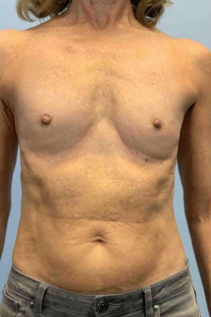 Breast Augmentation Before & After Patient #12281