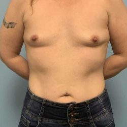 Breast Augmentation Before & After Patient #12295