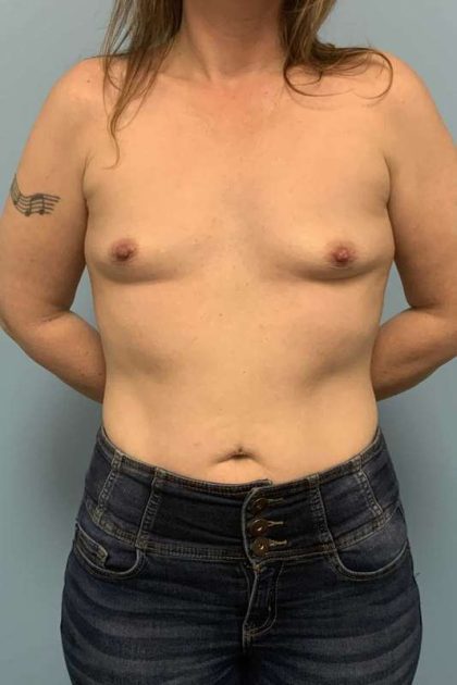 Breast Augmentation Before & After Patient #12295