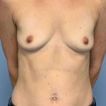 Breast Augmentation Before & After Patient #12302