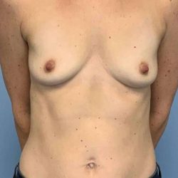Breast Augmentation Before & After Patient #12302