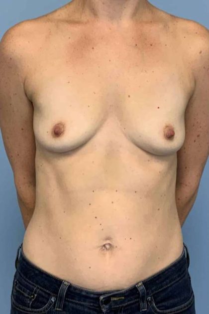 Breast Augmentation Before & After Patient #12302