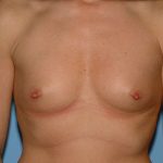Breast Augmentation Before & After Patient #12316
