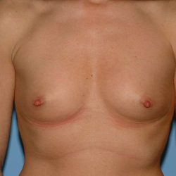 Breast Augmentation Before & After Patient #12316