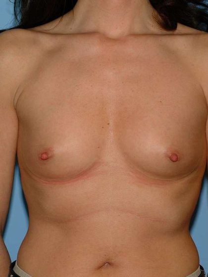 Breast Augmentation Before & After Patient #12316