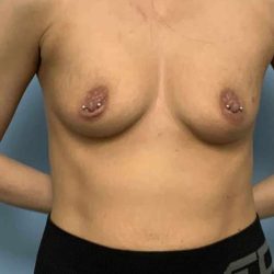 Breast Augmentation Before & After Patient #12323