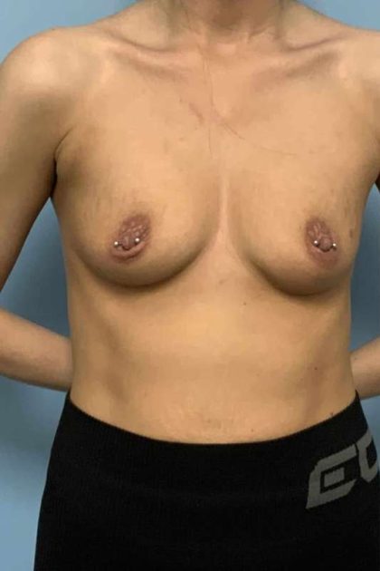 Breast Augmentation Before & After Patient #12323