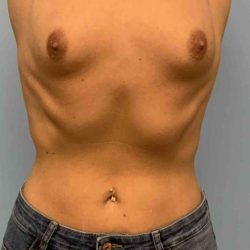 Breast Augmentation Before & After Patient #12330