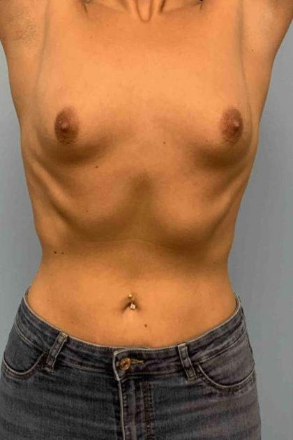 Breast Augmentation Before & After Patient #12330