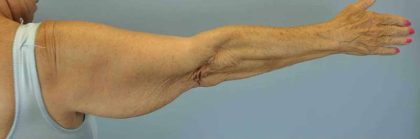 Brachioplasty Before & After Patient #12348