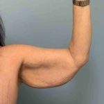 Brachioplasty Before & After Patient #12362