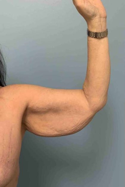 Brachioplasty Before & After Patient #12362