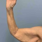 Brachioplasty Before & After Patient #12371