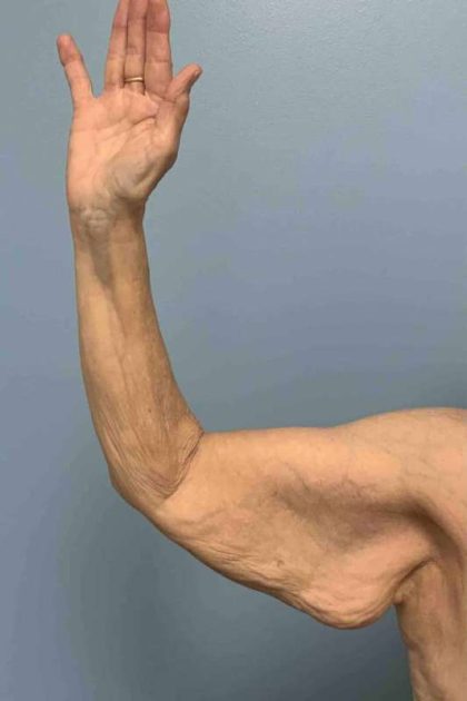 Brachioplasty Before & After Patient #12371