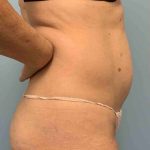 VASER Liposelection Before & After Patient #10446