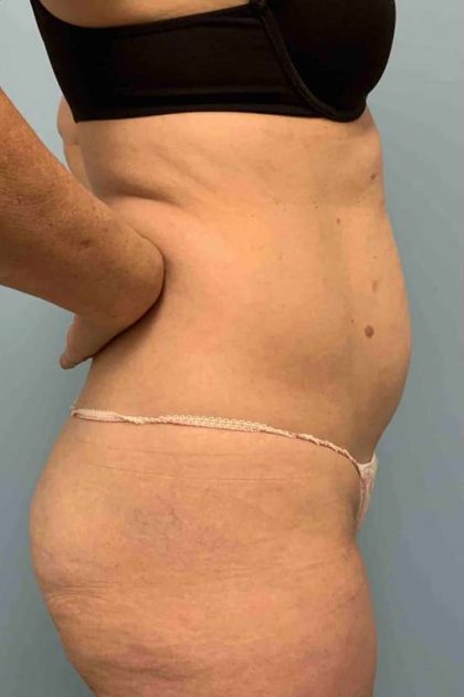 VASER Liposelection Before & After Patient #10446