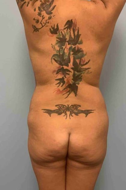 VASER Liposelection Before & After Patient #10479