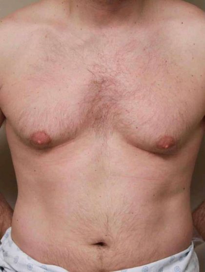 VASER Liposelection Before & After Patient #10486