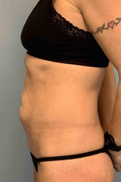 VASER Liposelection Before & After Patient #10493