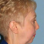 VASER Liposelection Before & After Patient #10500