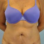 VASER Liposelection Before & After Patient #10511