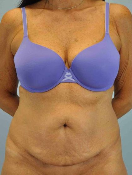 VASER Liposelection Before & After Patient #10511