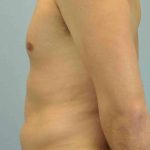 VASER Liposelection Before & After Patient #10527