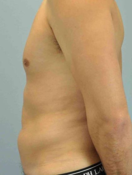 VASER Liposelection Before & After Patient #10527