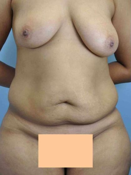 VASER Liposelection Before & After Patient #10534