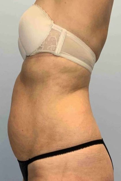 VASER Liposelection Before & After Patient #10407