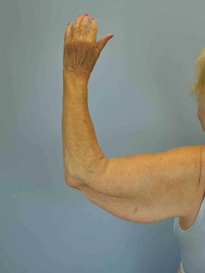 VASER Liposelection Before & After Patient #10615