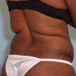 VASER Liposelection Before & After Patient #10631