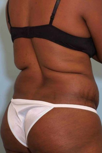 VASER Liposelection Before & After Patient #10631