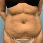 VASER Liposelection Before & After Patient #10638