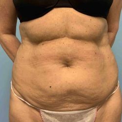 VASER Liposelection Before & After Patient #10638