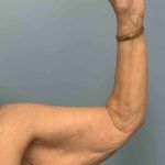 VASER Liposelection Before & After Patient #10652