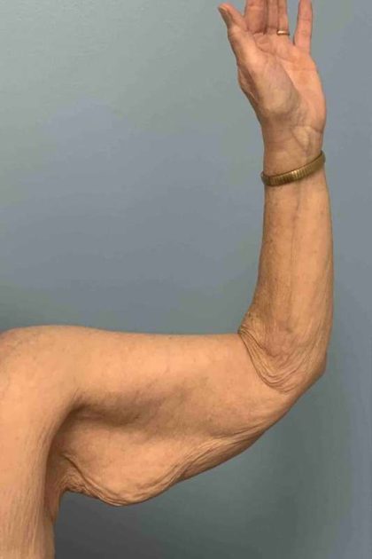 VASER Liposelection Before & After Patient #10652