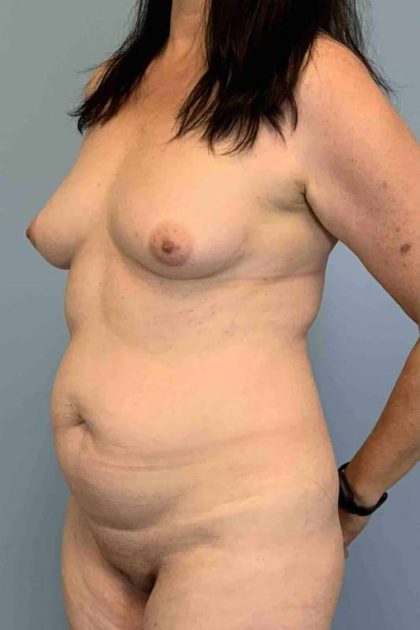 VASER Liposelection Before & After Patient #10670