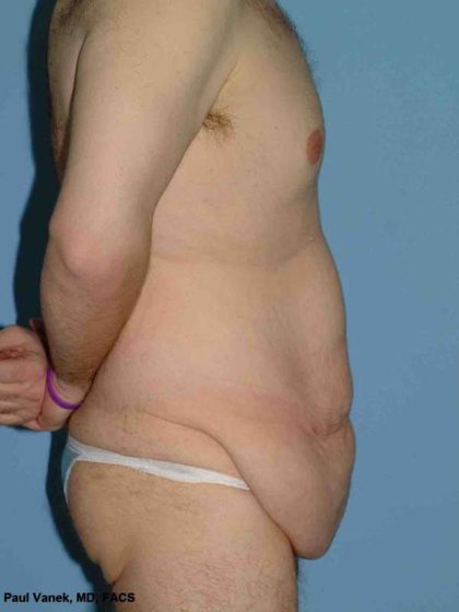 VASER Liposelection Before & After Patient #10400