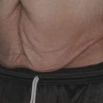Tummy Tuck Before & After Patient #10689