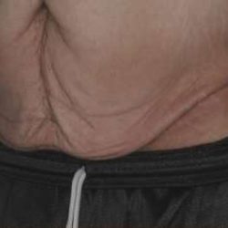 Tummy Tuck Before & After Patient #10689