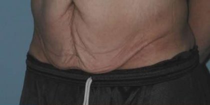 Tummy Tuck Before & After Patient #10689