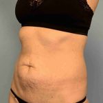 Tummy Tuck Before & After Patient #10721