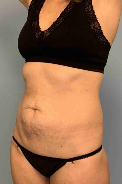 Tummy Tuck Before & After Patient #10721