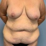Tummy Tuck Before & After Patient #10728