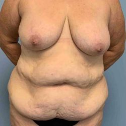 Tummy Tuck Before & After Patient #10728