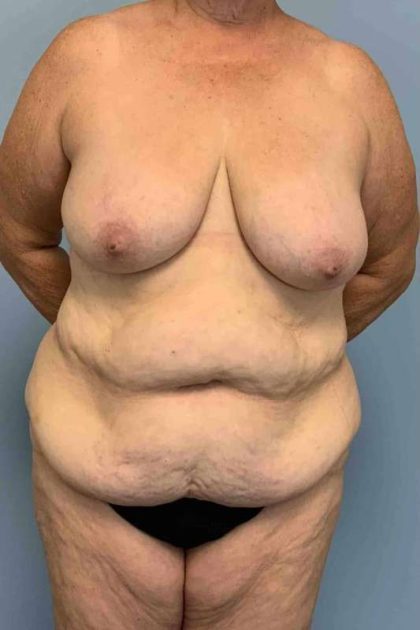 Tummy Tuck Before & After Patient #10728