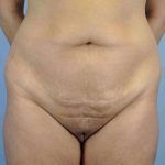 Tummy Tuck Before & After Patient #10742