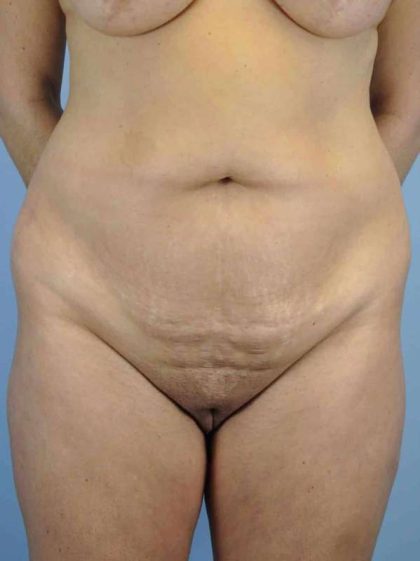 Tummy Tuck Before & After Patient #10742
