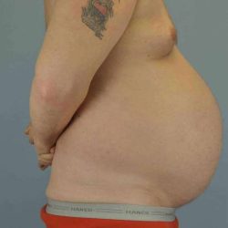 Tummy Tuck Before & After Patient #10749